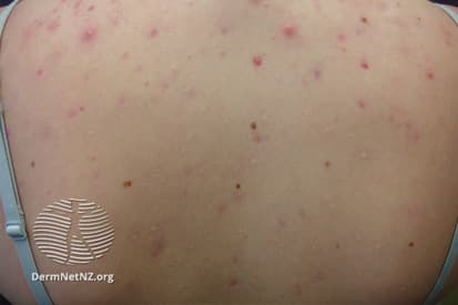 acne-4 (1)