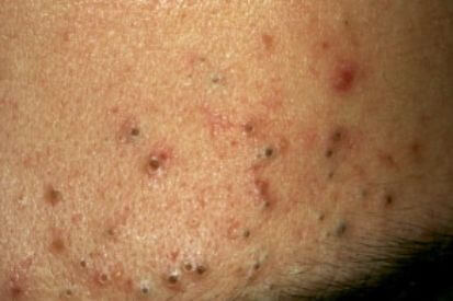 acne-2
